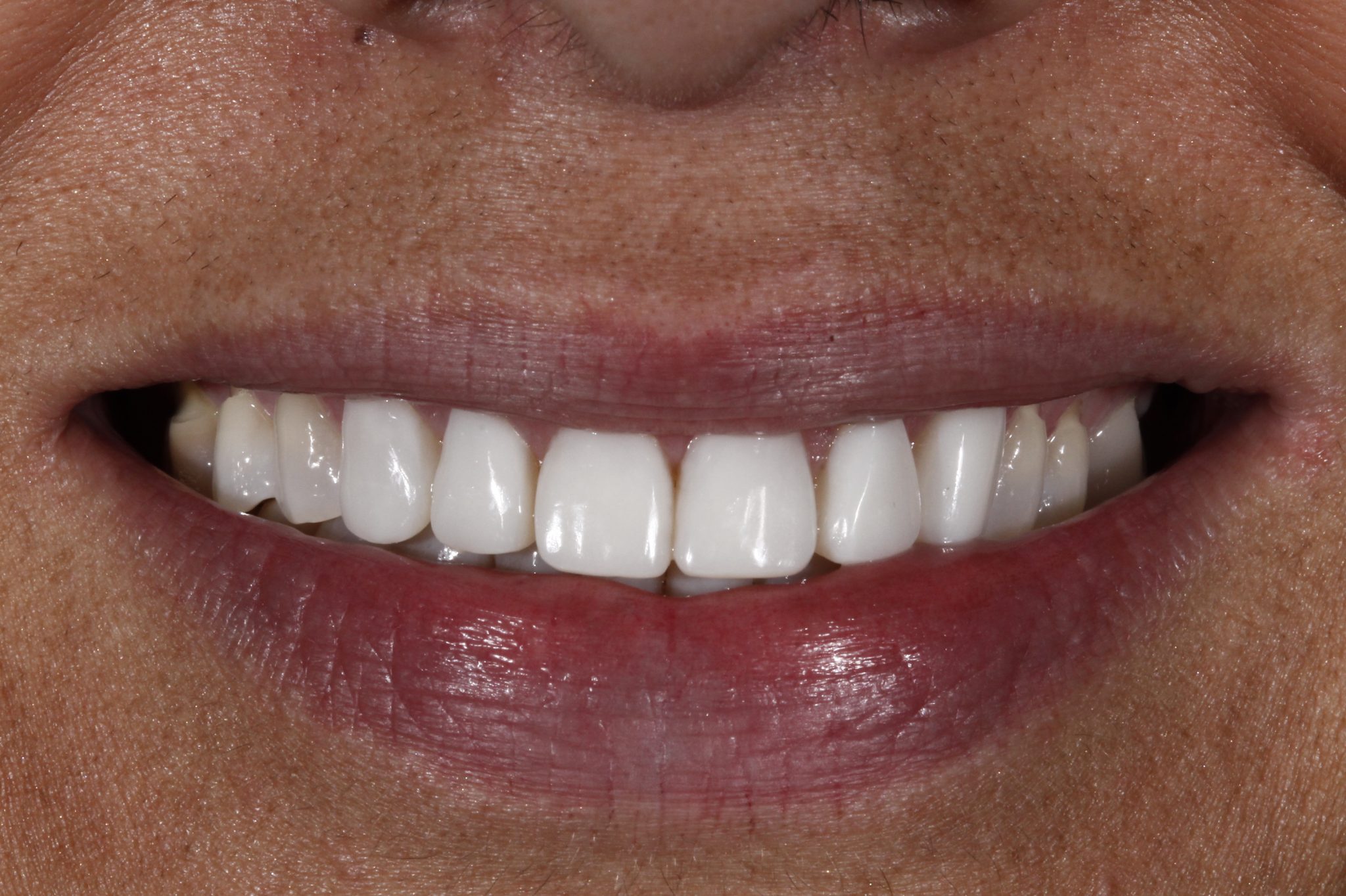 Dental Implant - After Treatment