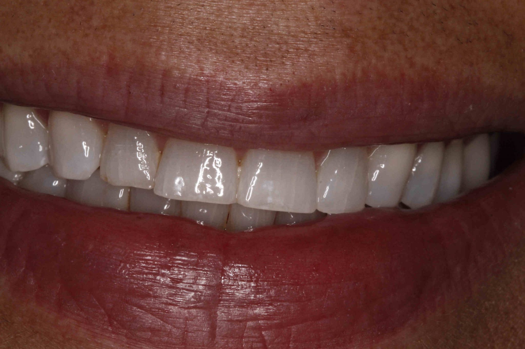 Dental Implant - Before Treatment